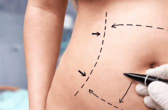 How Does Liposculpture Work? A Step-by-Step Look at the Procedure