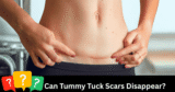 Do Tummy Tuck Scars Disappear—Or Can They Become a Masterpiece?